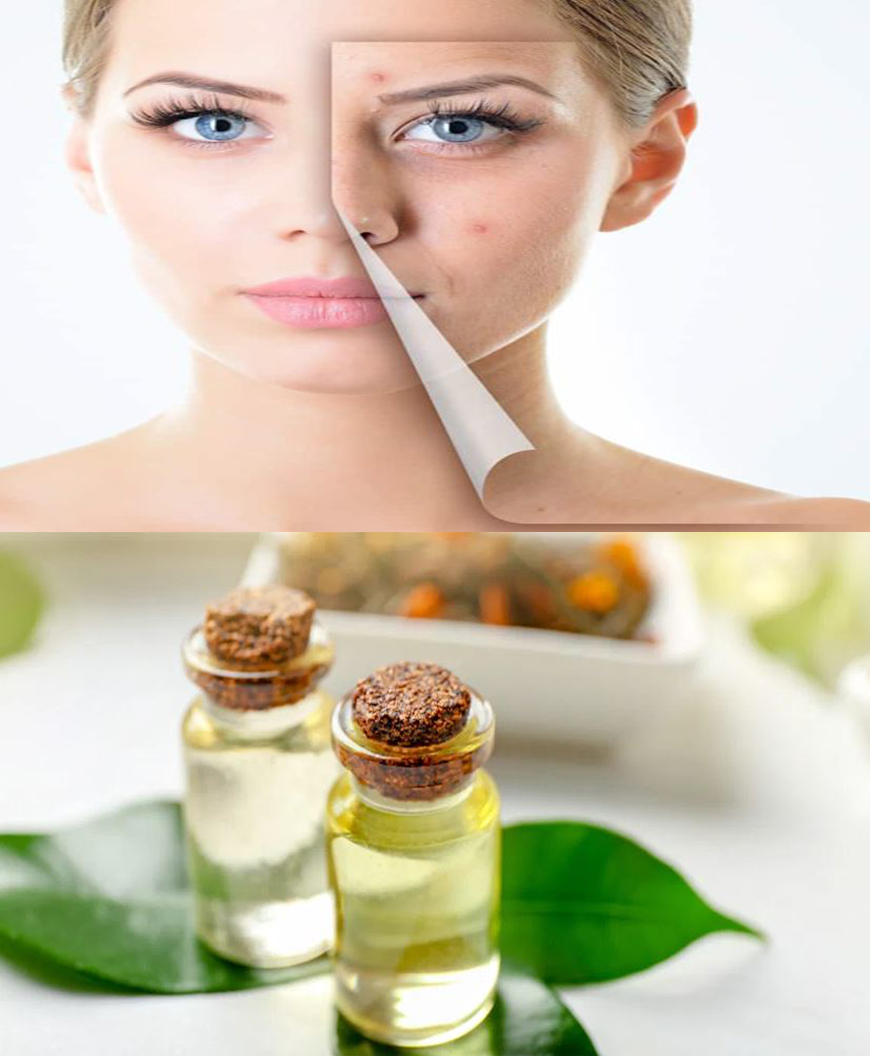 Huiles naturelles et remèdes naturels efficaces pour traiter l'acné et se débarrasser de ses effets